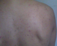 怎么快速祛除背部肉(背部肌肉怎么消除)