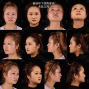 脸蛋怎么减肥(脸型怎么减肥)