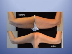 蝴蝶手臂怎么瘦(怎样才能减掉蝴蝶臂?)