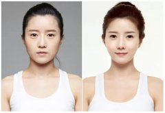 怎么瘦脸变成V字形(怎么让脸变成v字形)