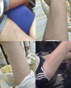 去肥胖纹肥胖纹怎么祛除(怎么样去除肥胖纹)