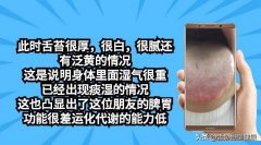 手指虚胖怎么办(手指胖胖的怎么办)