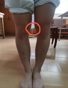 腿不直怎么矫正(六岁宝宝腿不直怎么矫正)