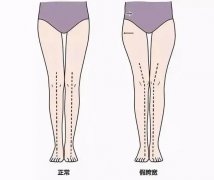 走路多小腿变粗怎么能瘦下来(走路减肥小腿会变粗吗)