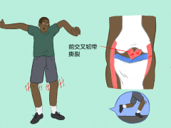 膝盖韧带撕裂怎么办(膝盖韧带撕裂怎么办恢复)