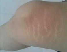 肥胖纹怎么产生(肥胖纹怎么形成原因)