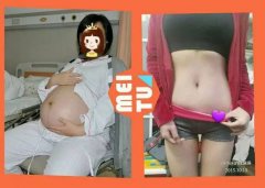 快走瘦腿成功案例(快走减腿吗)