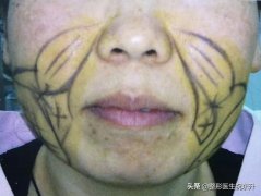 脂肪脸怎么瘦(脂肪脸怎么瘦操)