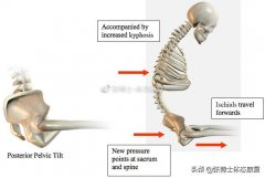 盆骨不正怎么矫正(盆骨不正矫正动作)